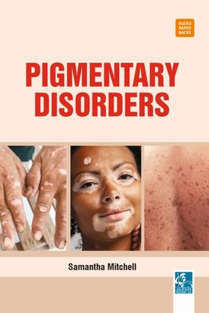 Pigmentary Disorders