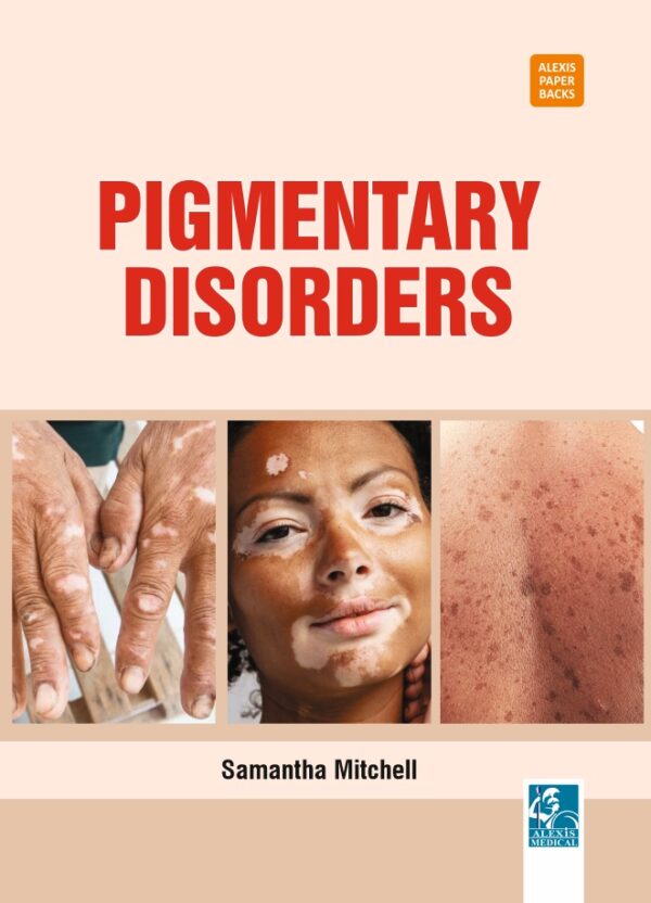 Pigmentary Disorders